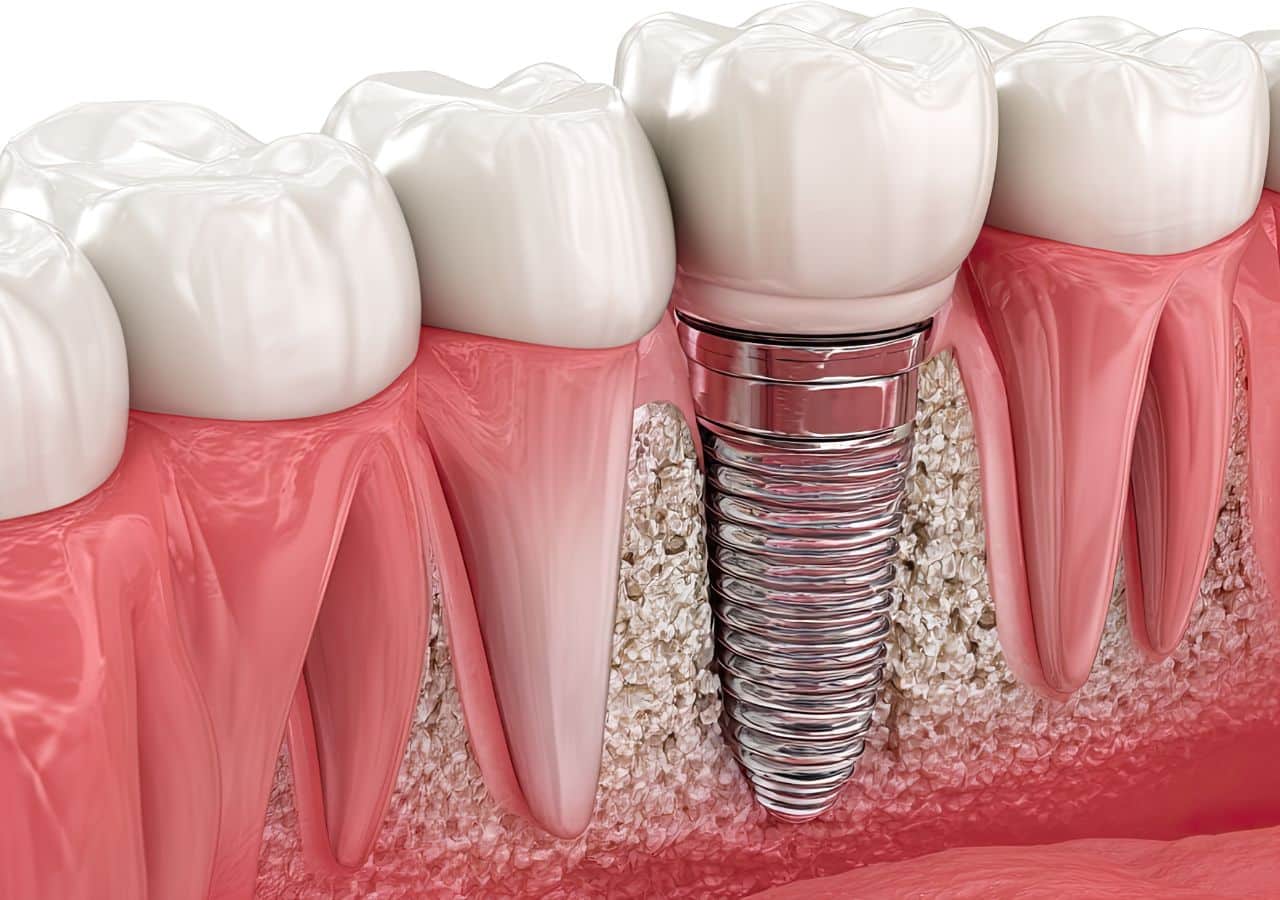 implants in corby