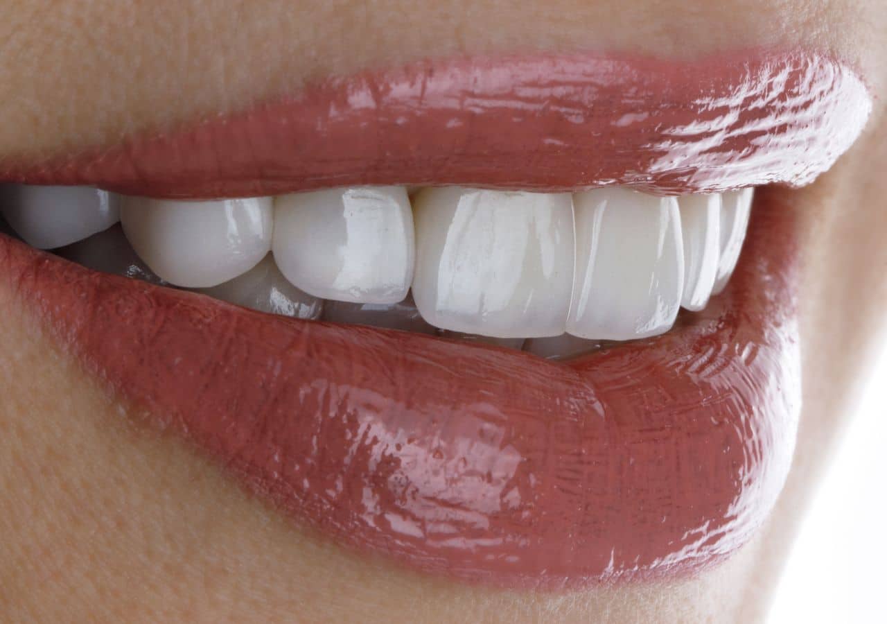 veneers in corby