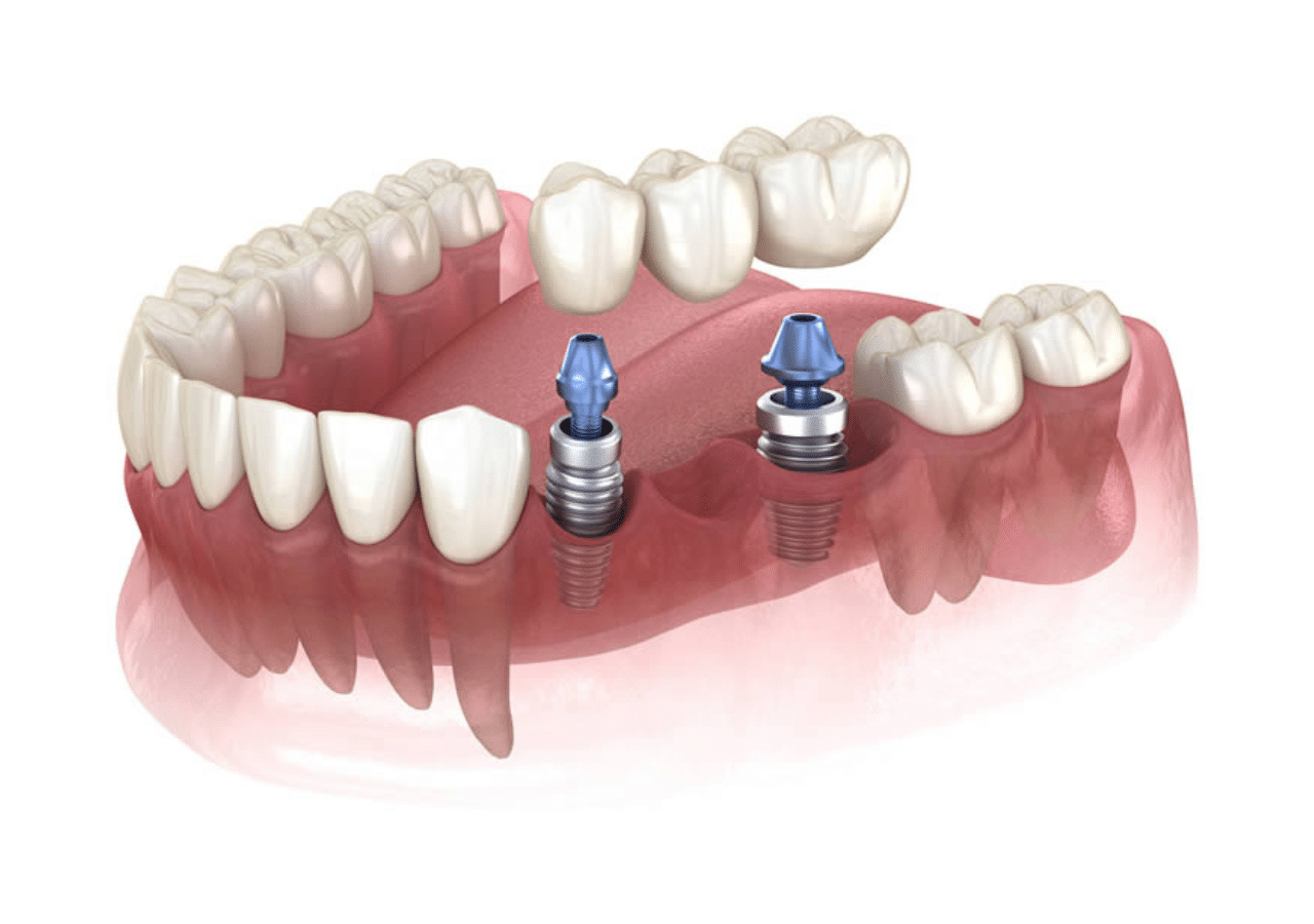 dental implants in duston