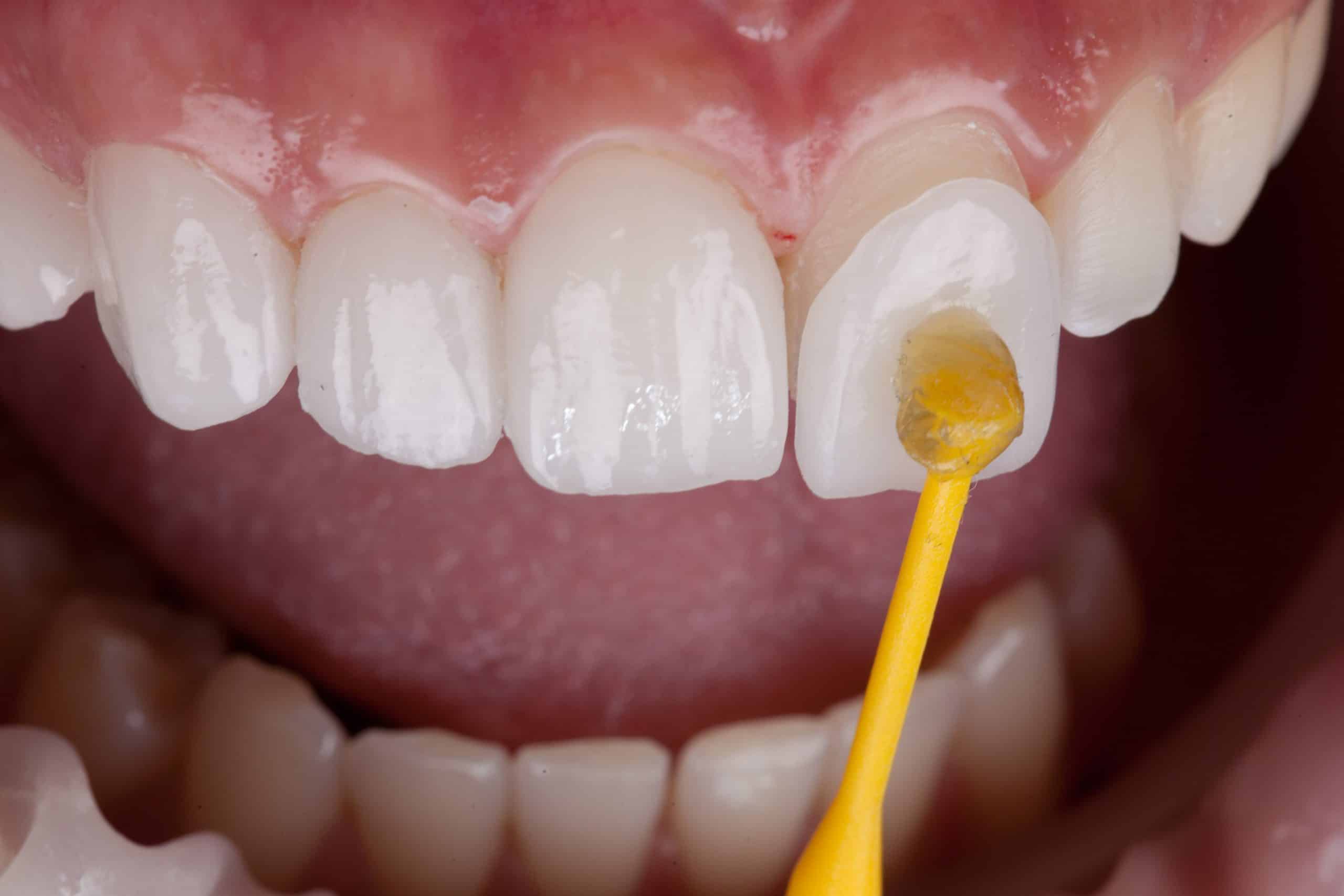 vveneers in duston