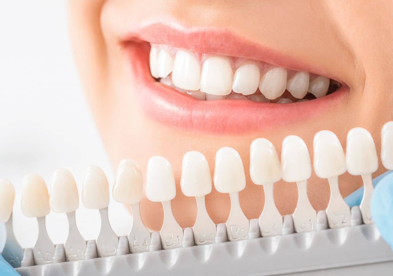 teeth whitening In corby