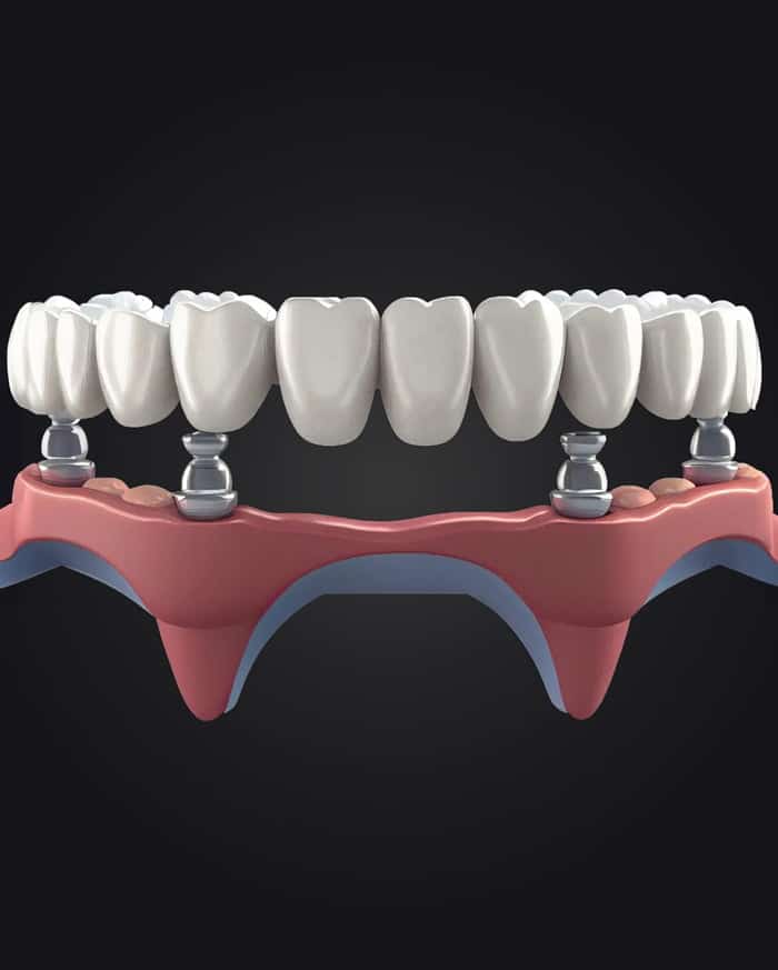 Dental Implants